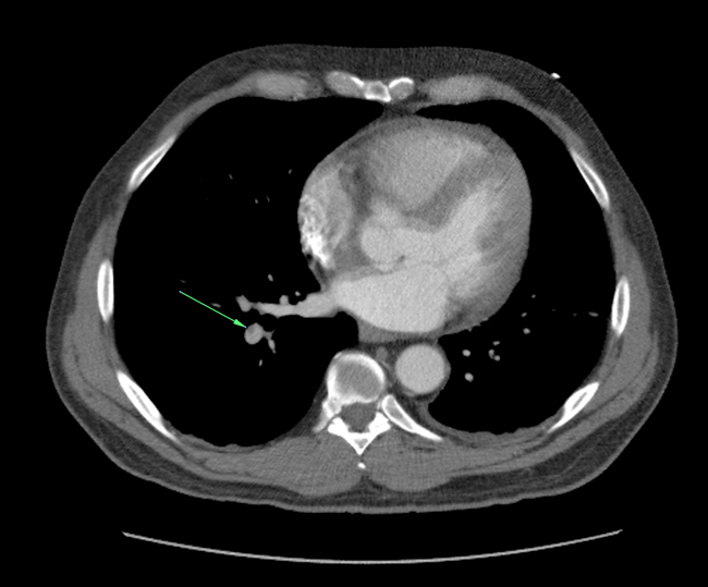 bilateral pulmonary emboli 5