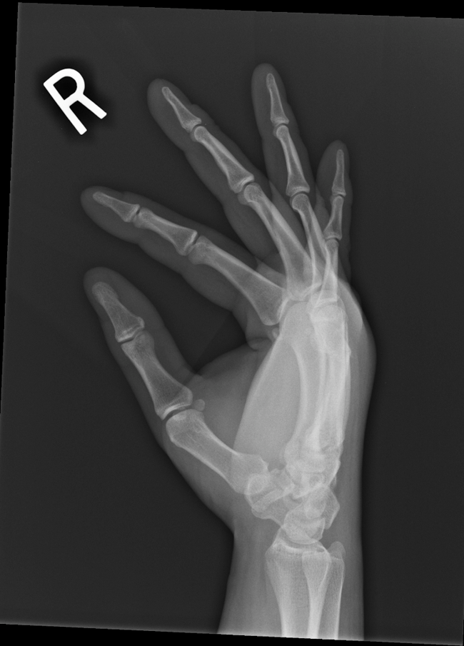 boxers-fracture-2