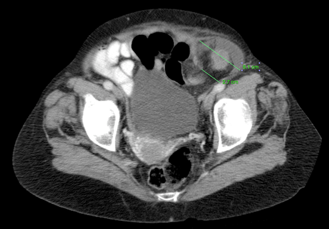 incarcerated-inguinal-hernia-2