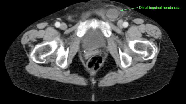 incarcerated-inguinal-hernia-3