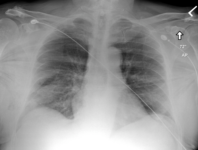 subcutaneous-emphysema